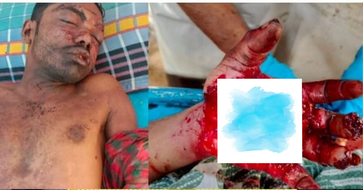 শার্শায় বোমা বিস্ফোরণে আহত বিপ্লবকে ঢাকায় পাঠানো হচ্ছে