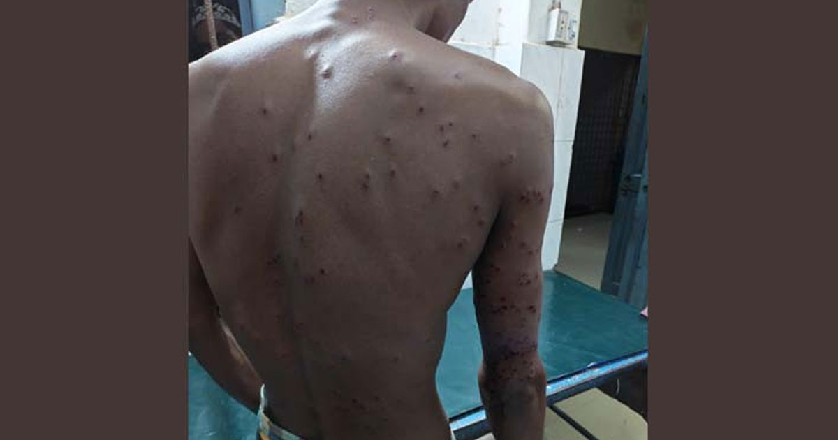 বিএসএফের গুলিতে বাংলাদেশি আহত