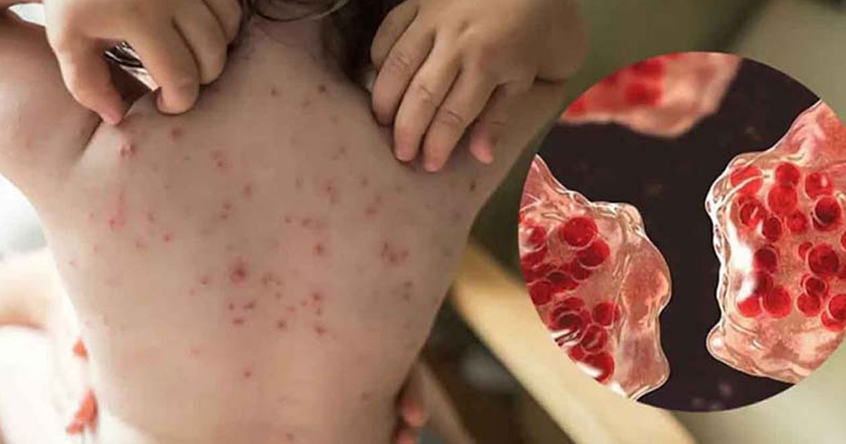 হাম ও উপসর্গে আরো ৩ শিশুর মৃত্যু, আক্রান্ত ১১৭০