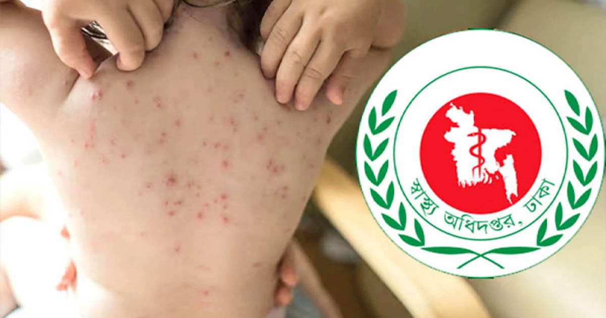 হামের উপসর্গে ২৪ ঘণ্টায় আরও ৩ শিশুর মৃত্যু