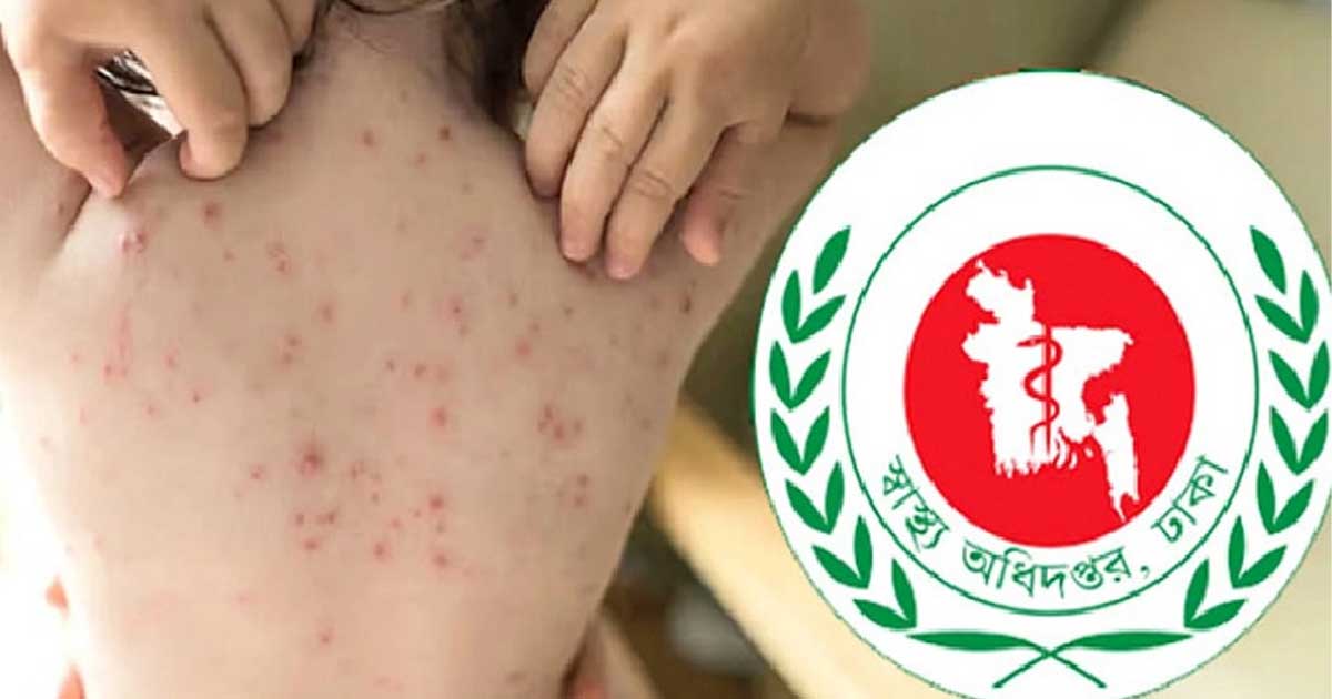 হামের উপসর্গ নিয়ে আরও ৫ জনের মৃত্যু, মোট মৃত্যু বেড়ে ৩৮