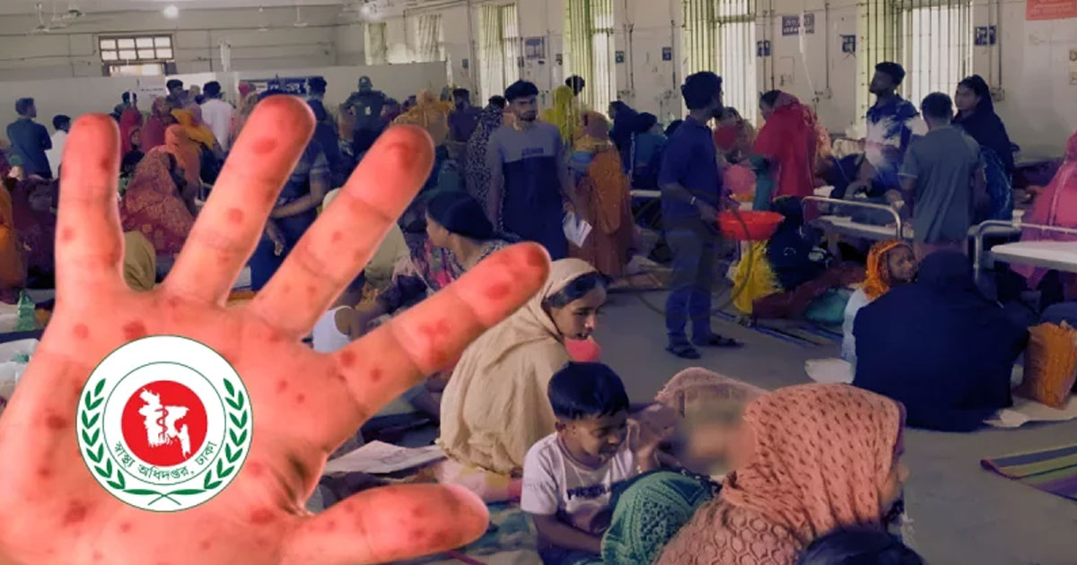 ২৪ ঘণ্টায় হাম উপসর্গে আরও ১১ জনের মৃত্যু