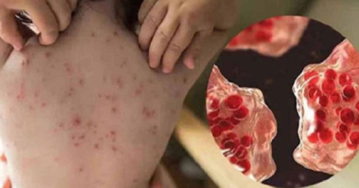 হাম উপসর্গে আরও ৬ শিশুর মৃত্যু