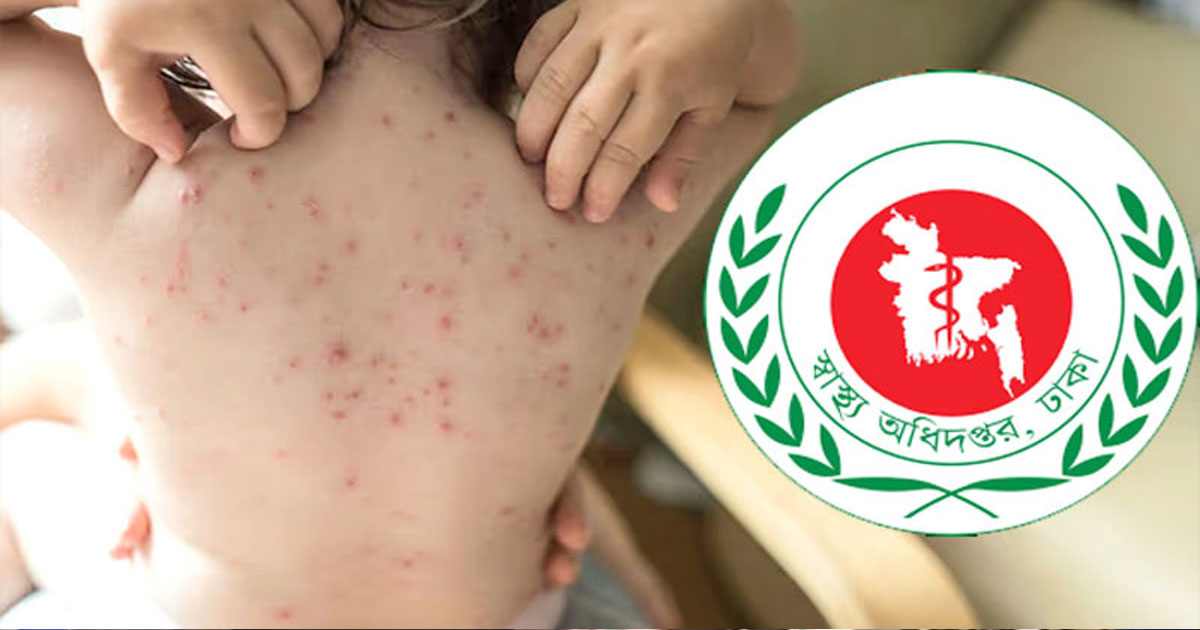 হাম ও উপসর্গে আরও ১০ শিশুর মৃত্যু