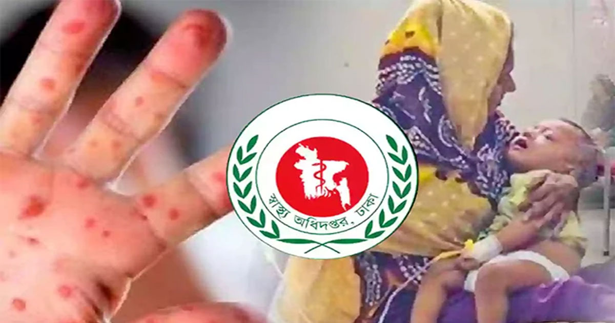হাম ও উপসর্গে আরও ৮ শিশুর মৃত্যু
