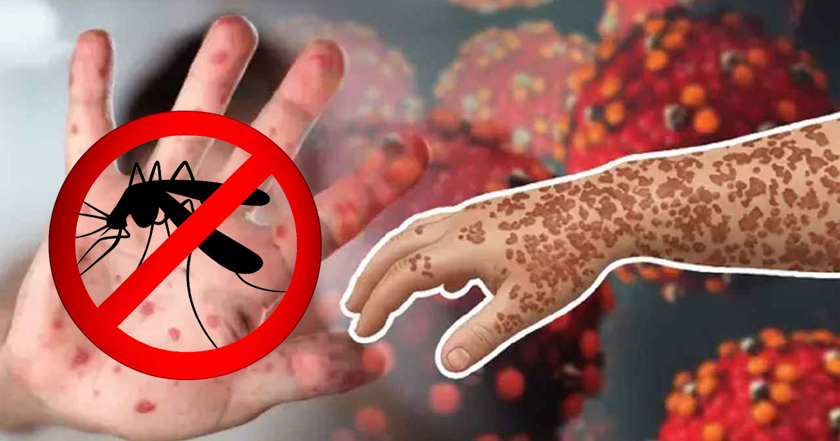 হাম উপসর্গে ৩ ও ডেঙ্গুতে একজনের মৃত্যু