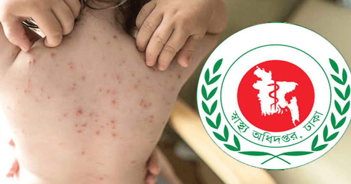হাম উপসর্গে আরও ৫ শিশুর মৃত্যু