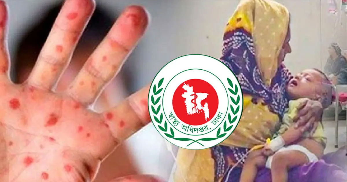 হাম উপসর্গে আরও তিন শিশুর মৃত্যু