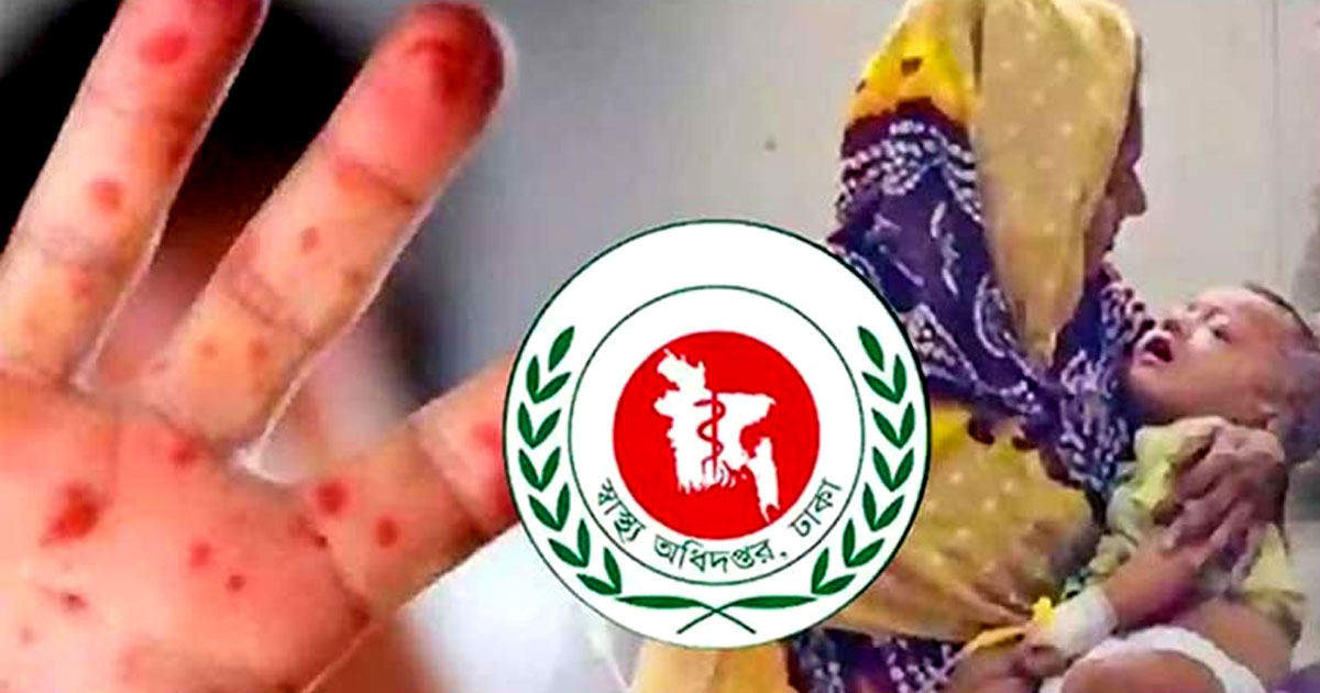 হাম উপসর্গ নিয়ে আরও ৩ শিশুর মৃত্যু, আক্রান্ত ১ হাজার ৮৯