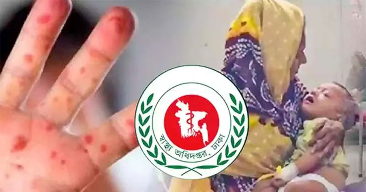 হাম উপসর্গে একদিনে আরও ৪ শিশুর মৃত্যু