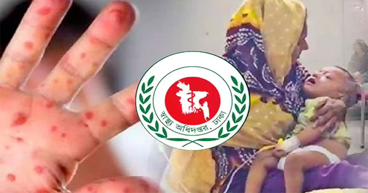 হাম উপসর্গে আরও ৩ শিশুর মৃত্যু