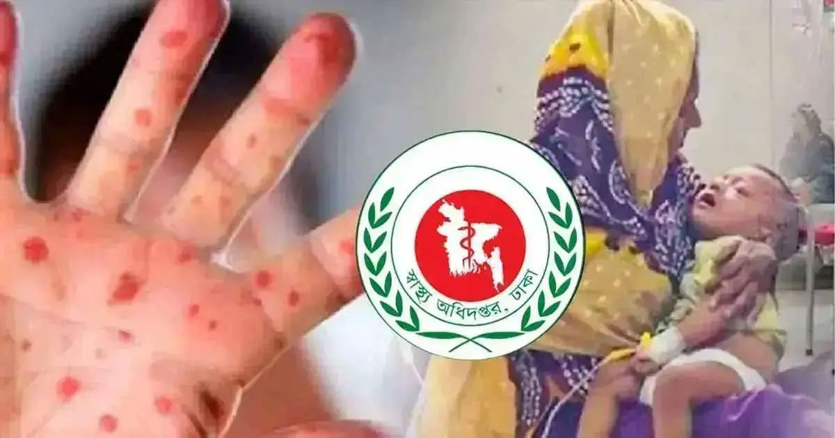 হাম উপসর্গে আরও ৩ শিশুর মৃত্যু