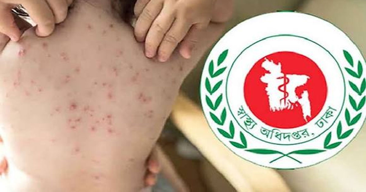 হামের উপসর্গে আরও ৪ শিশুর মৃত্যু