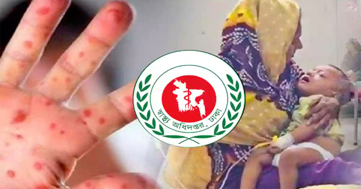 হামের উপসর্গে আরও ৭ মৃত্যু
