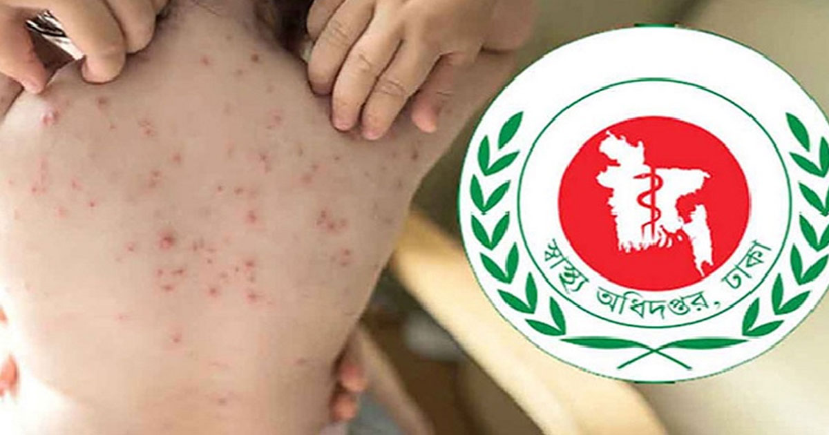 হাম উপসর্গে আরও ৪ শিশুর মৃত্যু