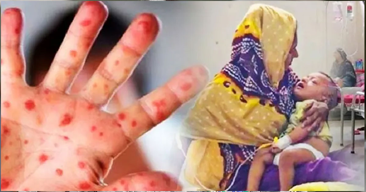 হাম উপসর্গে আরও ৭ জনের মৃত্যু
