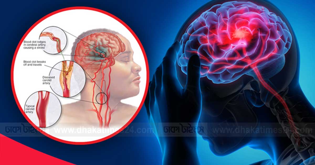 প্রতি চারজনের একজন রয়েছে স্ট্রোকের ঝুঁকিতে