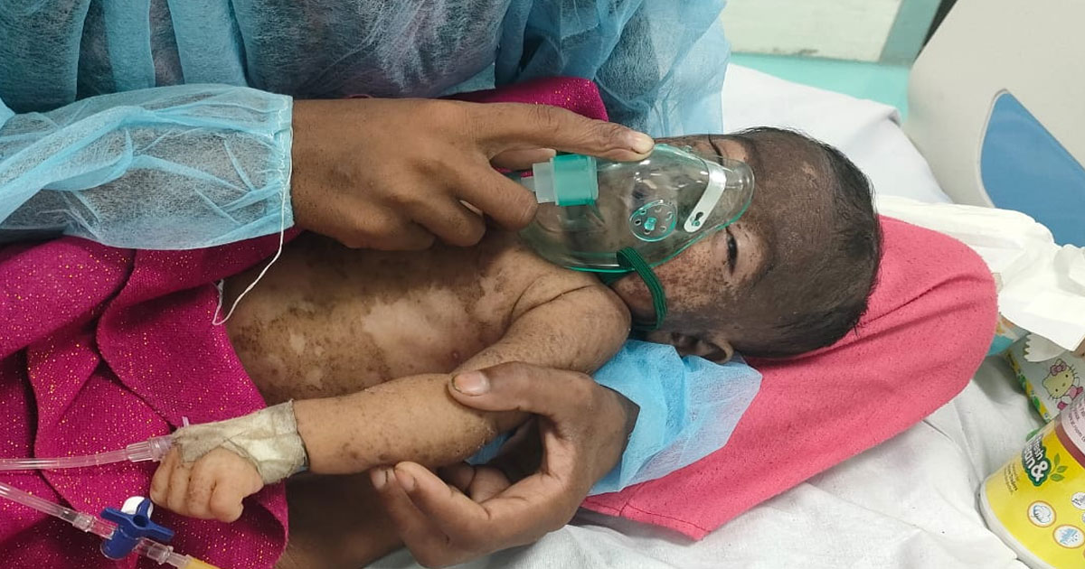 সিলেটে হামে আক্রান্ত শিশুর মৃত্যু: বাড়ছে সংক্রমণ ও উদ্বেগ