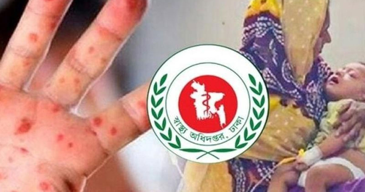 হাম ও উপসর্গে আরো ৯ মৃত্যু