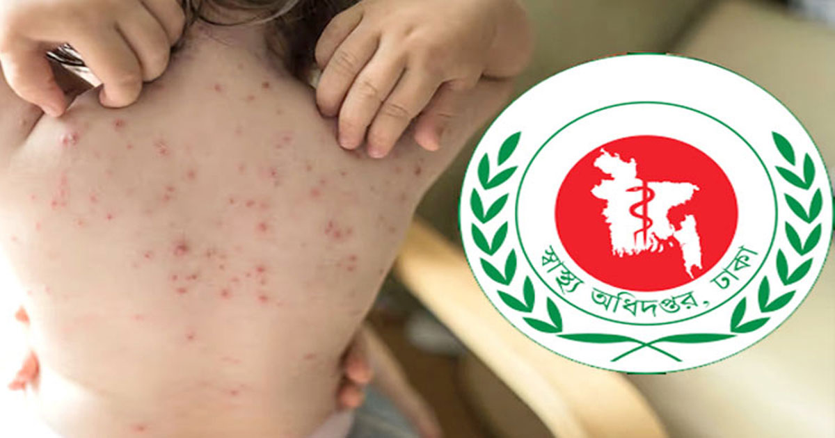 হাম ও উপসর্গে ২৪ ঘণ্টায় আরও ৭ শিশুর মৃত্যু