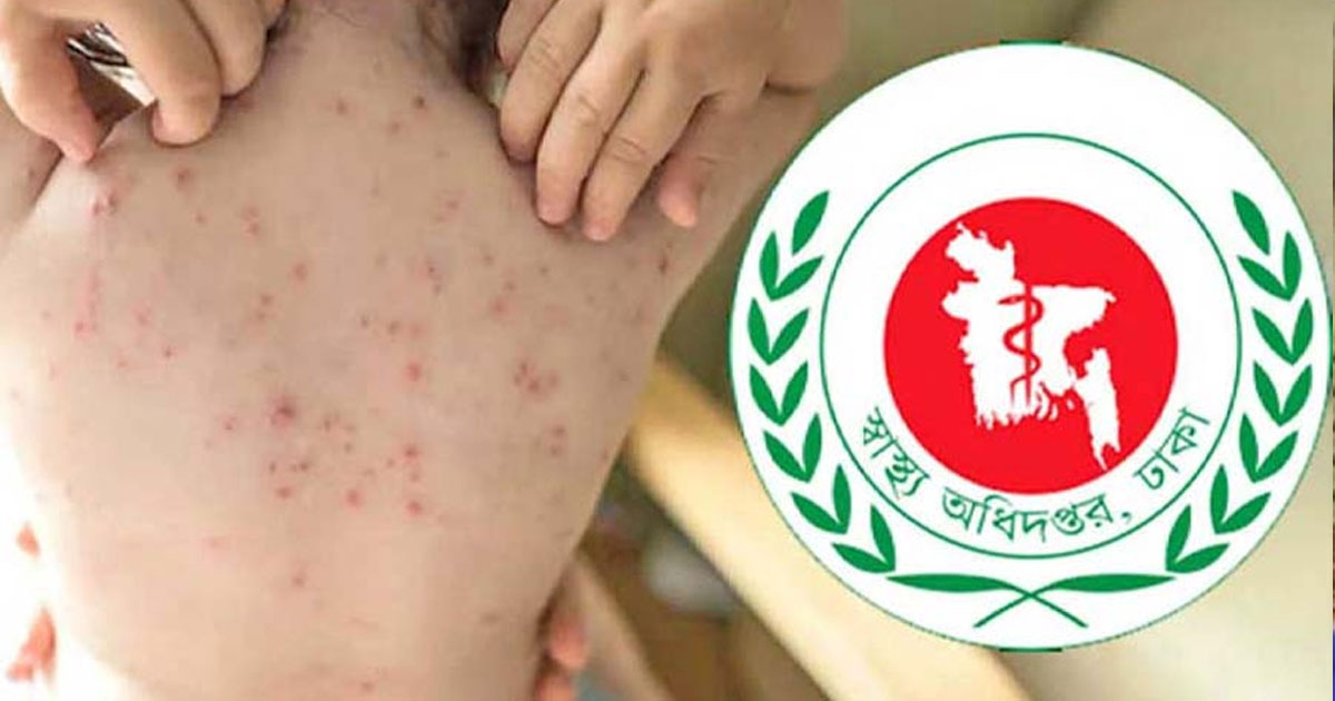 হাম ও উপসর্গে আরও ৬ মৃত্যু