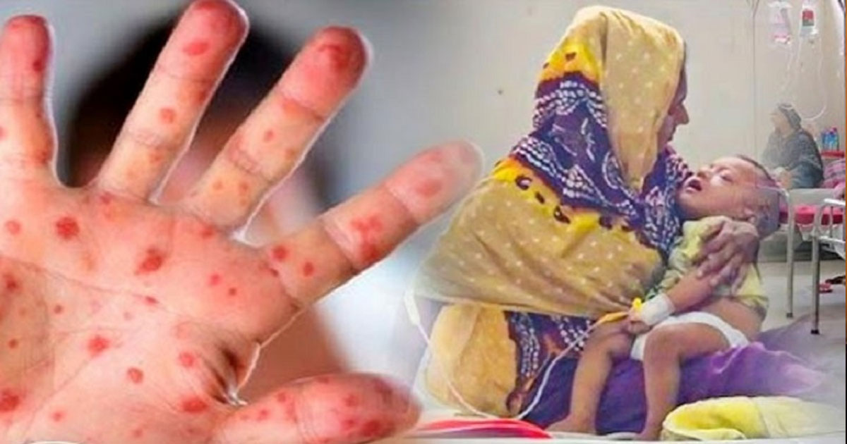 হাম ও উপসর্গে আরো ১৩ শিশুর মৃত্যু