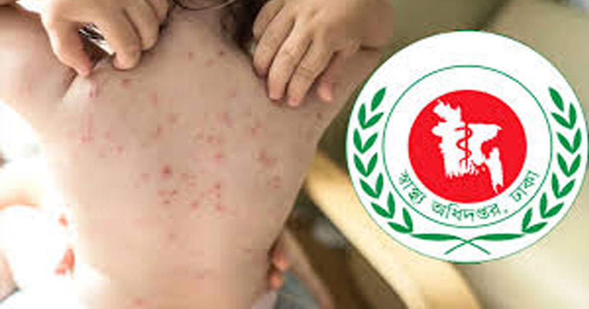 হাম ও উপসর্গে আরও ১০ শিশুর মৃত্যু